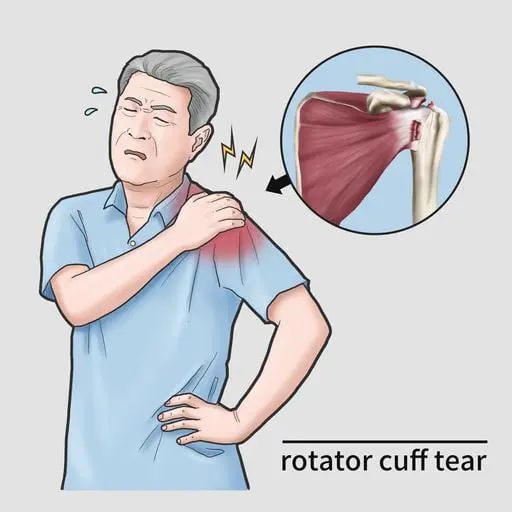 Rotator Cuff Tear Injury
