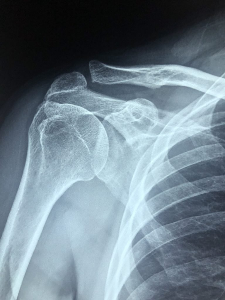 xray of rotator cuff