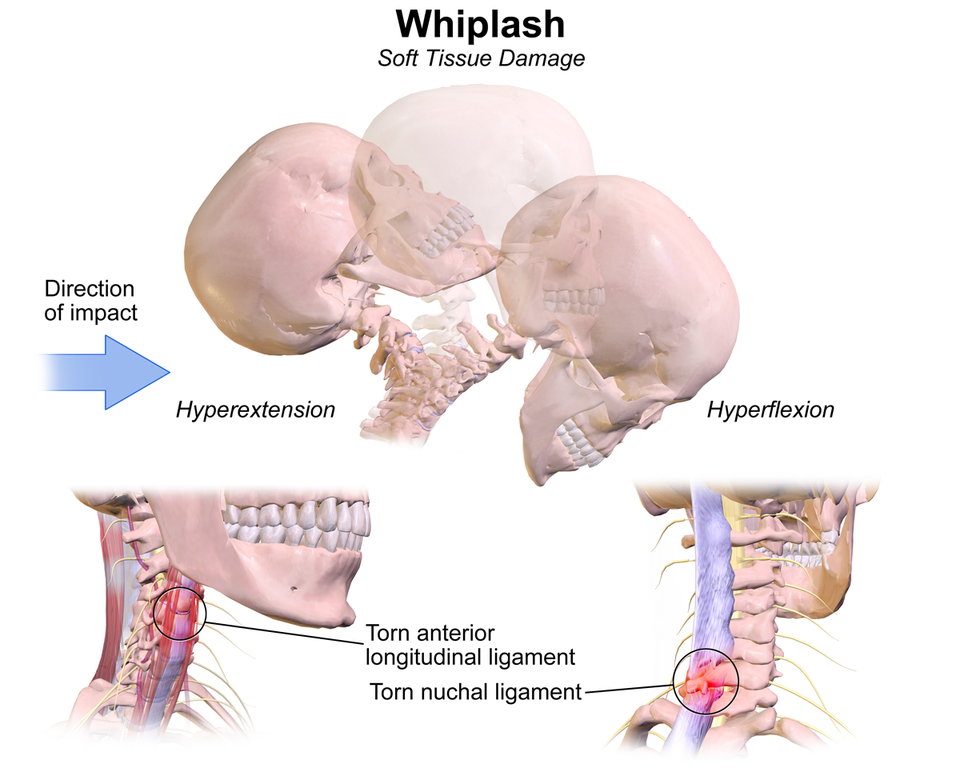 whiplash injury from auto accident diagram